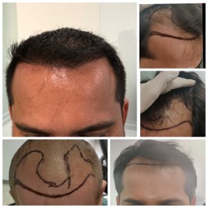 non shaveht 1