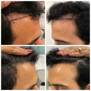 non shave ht